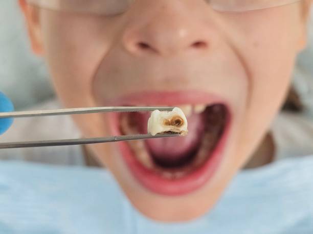 Best Knocked-Out Tooth Emergency  in Port St Joe, FL